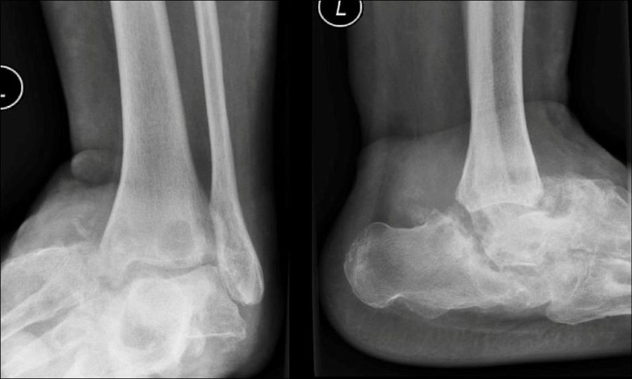 Pre-operative X-ray showing Charcot deformity