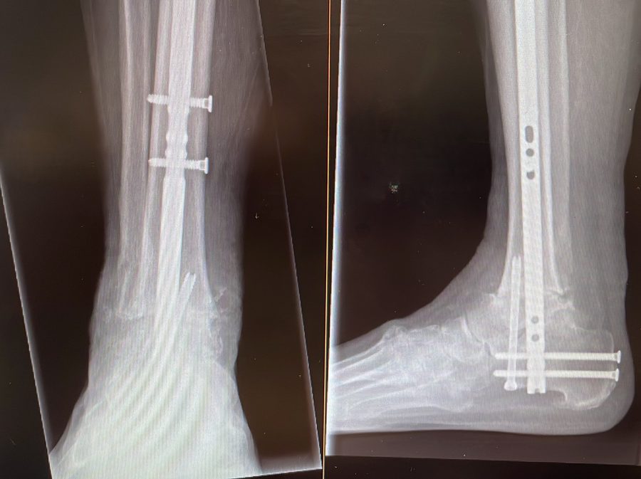 Post-operative AP X-ray showing intramedullary nail
