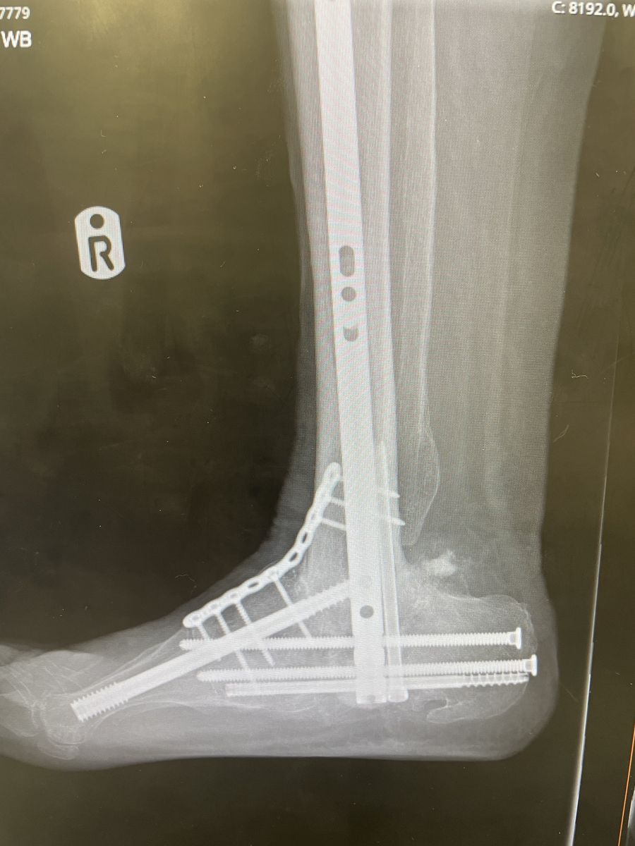 Post-operative lateral X-ray showing nail and screw fixation