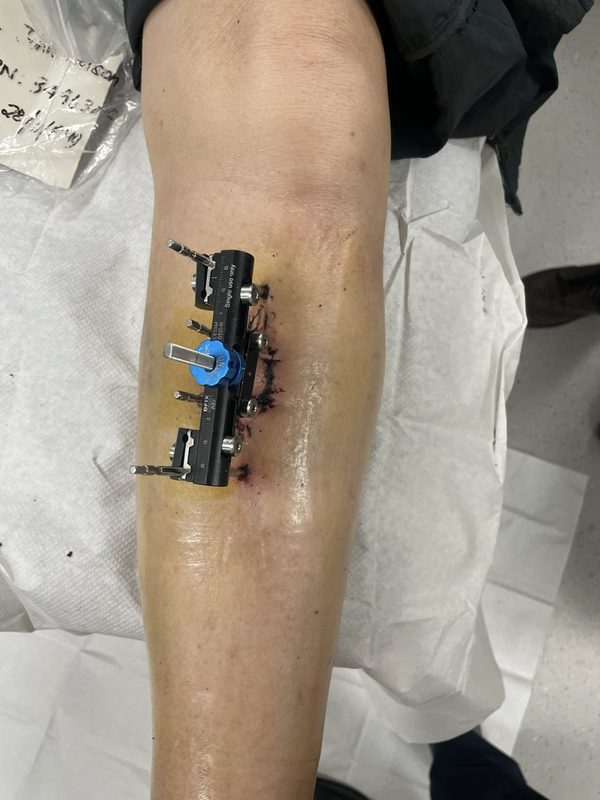 Cybion TTT device mounted on tibia