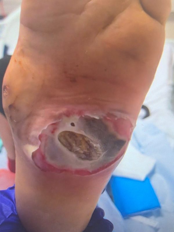 Large plantar diabetic ulcer prior to TTT