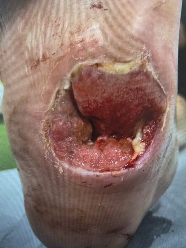 Severe heel ulceration prior to TTT
