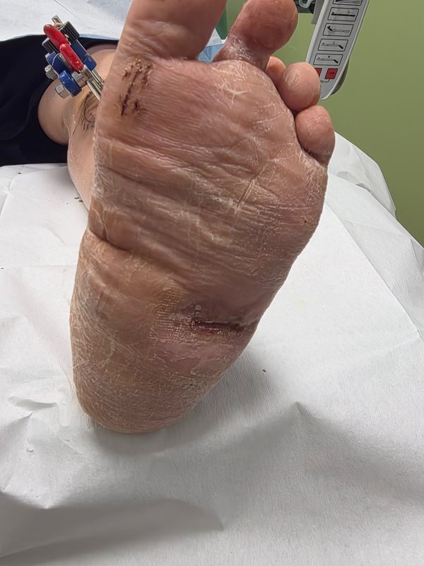 Healed foot post-TTT with Cybion device visible at ankle